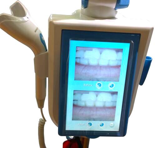 Magenta®MD-887B セルフホワイトニングLED照射器(カメラ機能付き)