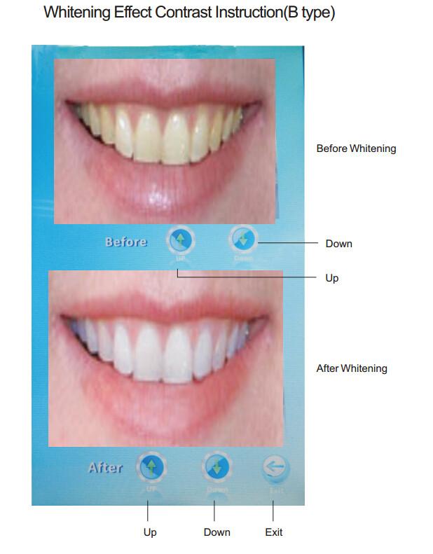 Magenta®MD-887B LEDホワイトニング照射器 | カメラ比較機能付き | 4